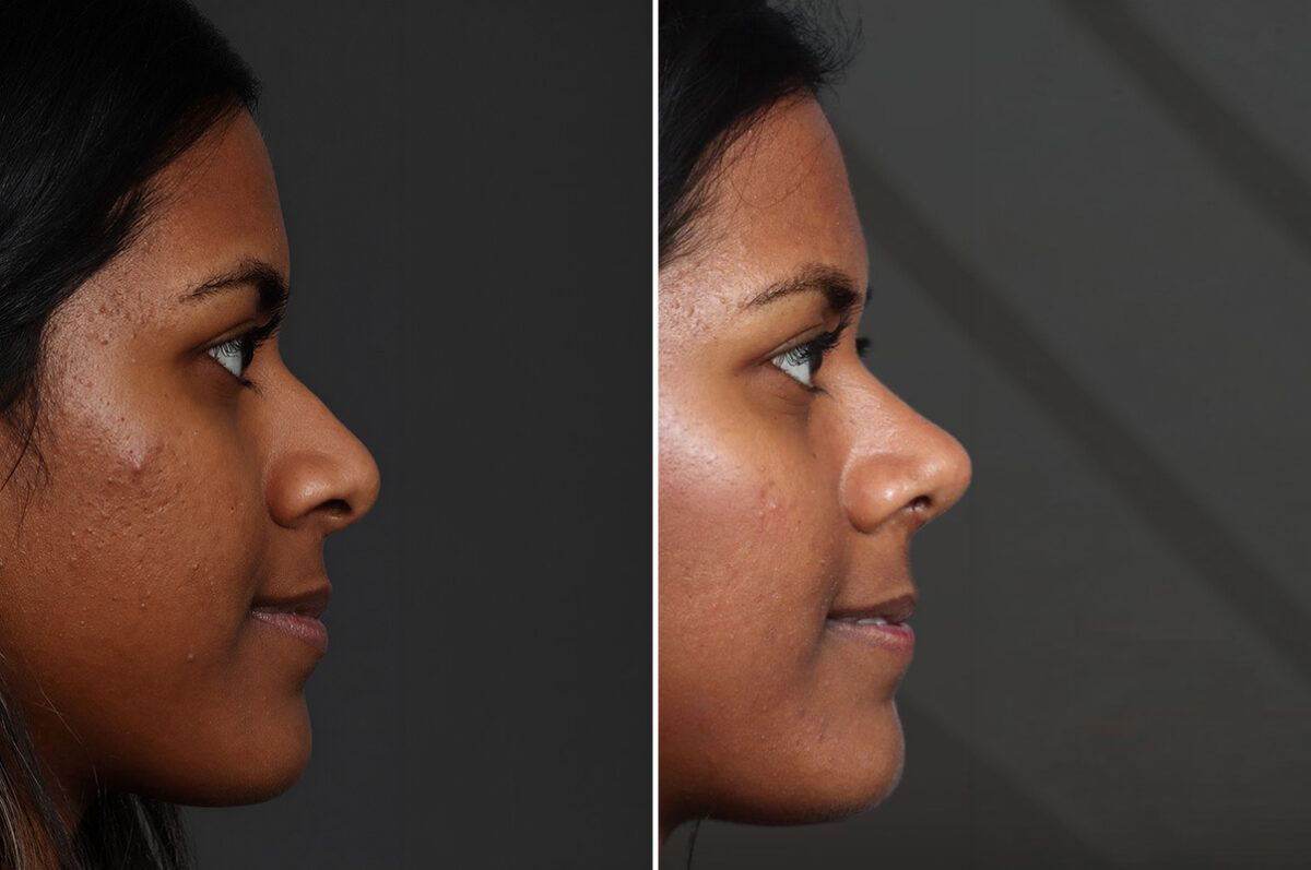 Rhinoplasty Before and After Photos in Princeton, NJ, Patient 19505