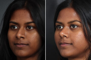 Rhinoplasty Before and After Photos in Princeton, NJ, Patient 19505
