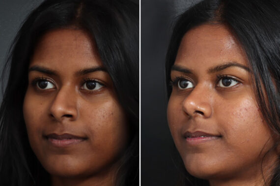 Rhinoplasty Before and After Photos in Princeton, NJ, Patient 19505