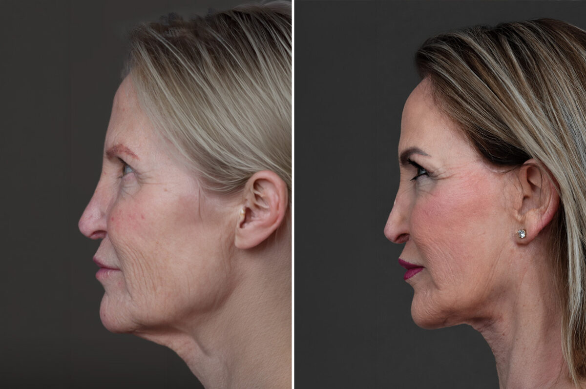 Deep Plane Facelift Before and After Photos in Princeton, NJ, Patient 19508