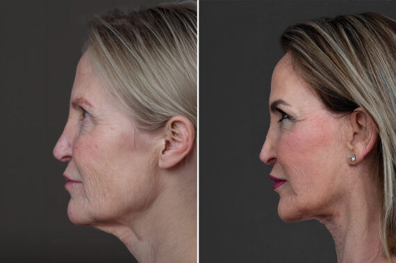 Deep Plane Facelift Before and After Photos in Princeton, NJ, Patient 19508