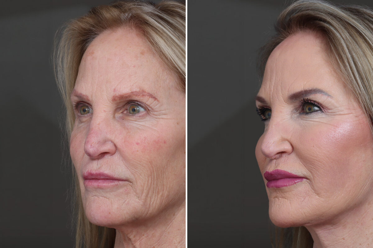 Deep Plane Facelift Before and After Photos in Princeton, NJ, Patient 19508