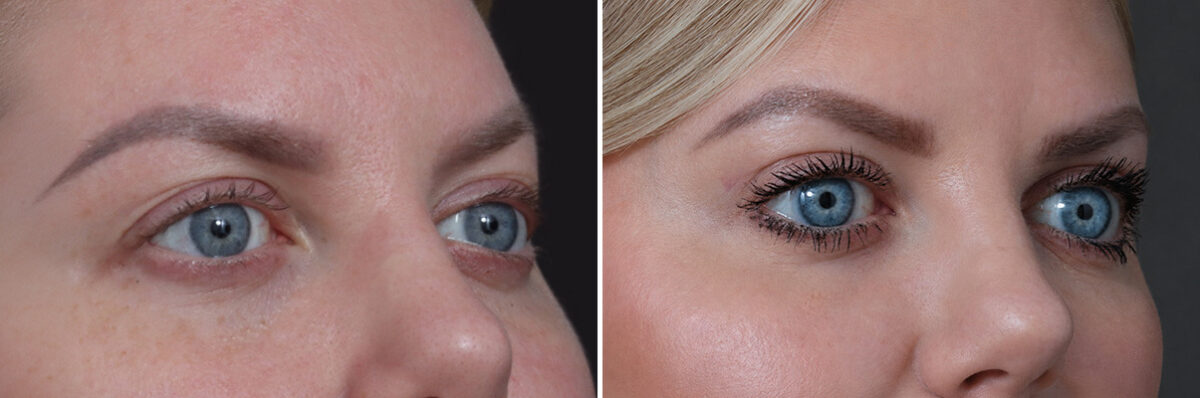Upper Eyelid Surgery Before and After Photos in Princeton, NJ, Patient 19512