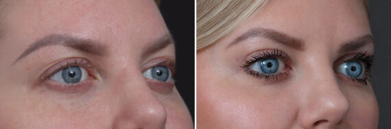 Upper Eyelid Surgery Before and After Photos in Princeton, NJ, Patient 19512