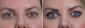 Upper Eyelid Surgery Before and After Photos in Princeton, NJ, Patient 19512