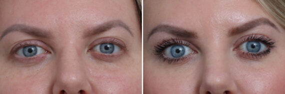Upper Eyelid Surgery Before and After Photos in Princeton, NJ, Patient 19512
