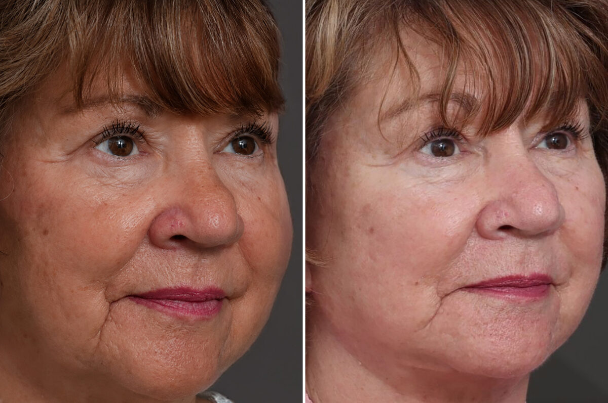 Facelift Before and After Photos in Princeton, NJ, Patient 19555