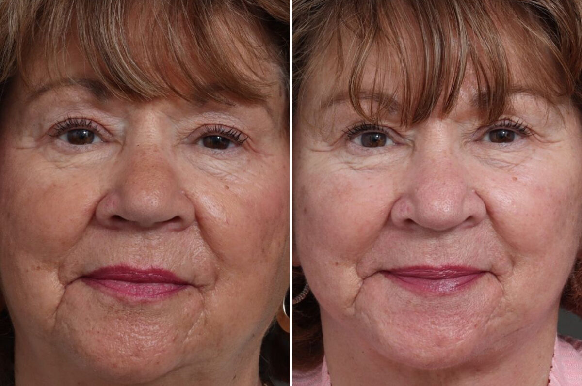 Facelift Before and After Photos in Princeton, NJ, Patient 19555