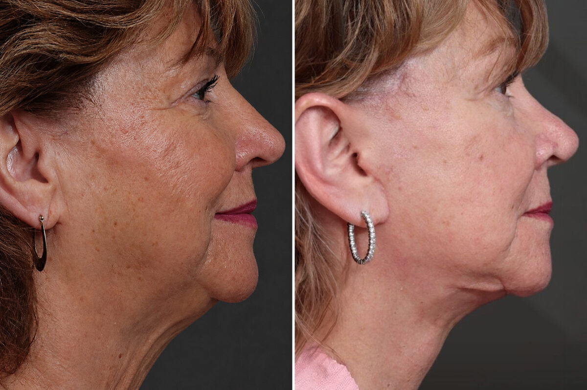 Facelift Before and After Photos in Princeton, NJ, Patient 19555