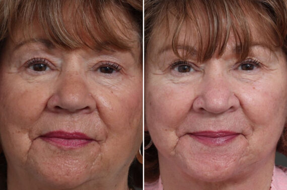 Facelift Before and After Photos in Princeton, NJ, Patient 19555