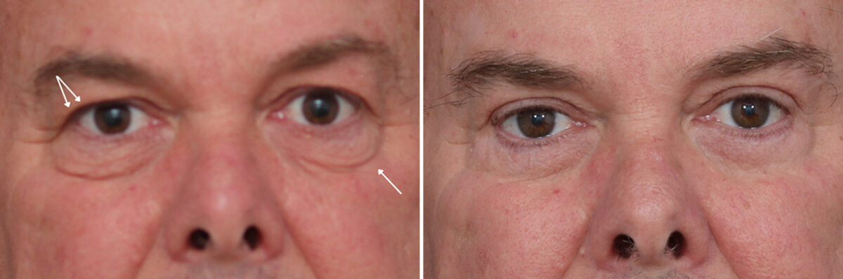Upper and Lower Eyelid Surgery Before and After Photos in Princeton, NJ, Patient 19559