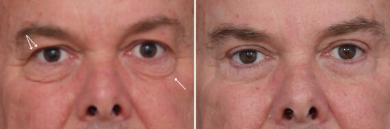 Upper and Lower Eyelid Surgery Before and After Photos in Princeton, NJ, Patient 19559