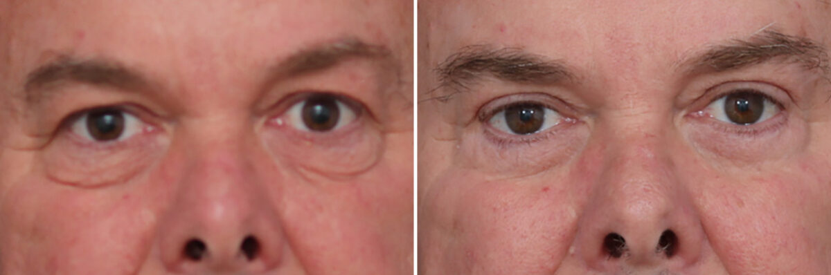 Upper and Lower Eyelid Surgery Before and After Photos in Princeton, NJ, Patient 19559