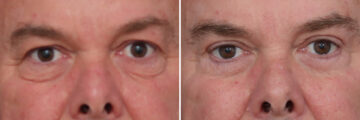 Upper and Lower Eyelid Surgery Before and After Photos in Princeton, NJ, Patient 19559