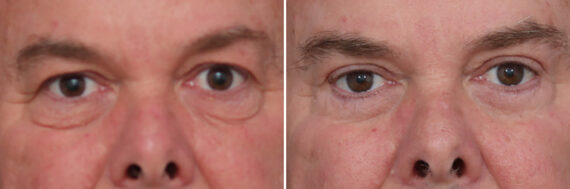 Upper and Lower Eyelid Surgery Before and After Photos in Princeton, NJ, Patient 19559