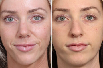 Rhinoplasty Before and After Photos in Princeton, NJ, Patient 19562