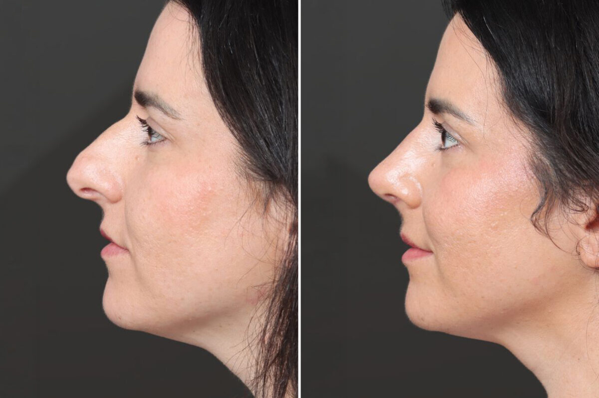 Rhinoplasty Before and After Photos in Princeton, NJ, Patient 19566