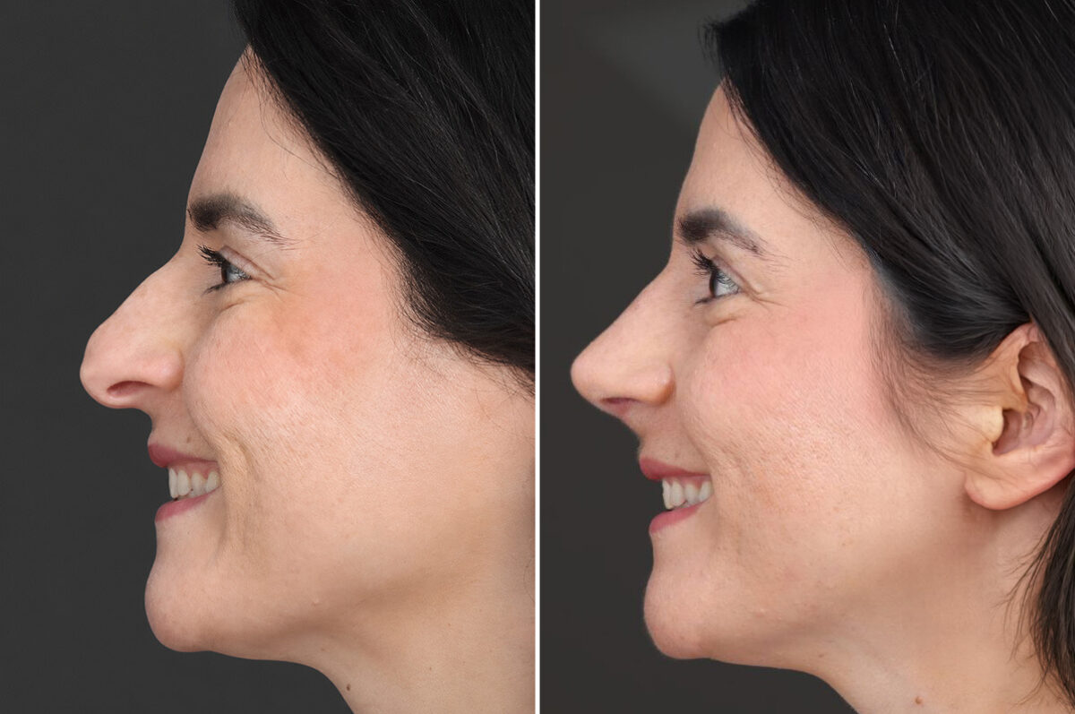 Rhinoplasty Before and After Photos in Princeton, NJ, Patient 19566