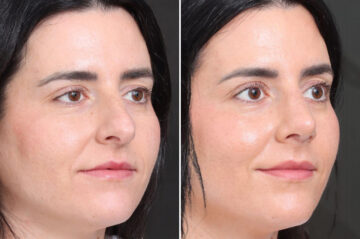 Rhinoplasty Before and After Photos in Princeton, NJ, Patient 19566