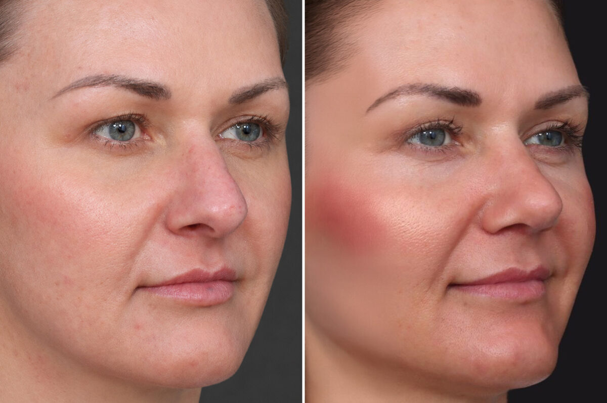 Rhinoplasty Before and After Photos in Princeton, NJ, Patient 19570