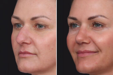 Rhinoplasty Before and After Photos in Princeton, NJ, Patient 19570