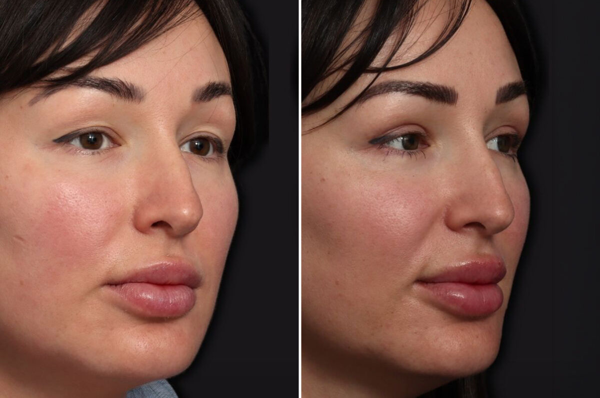Upper Eyelid Surgery Before and After Photos in Princeton, NJ, Patient 19573