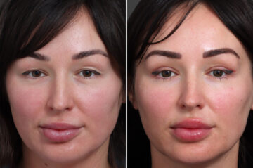 Upper Eyelid Surgery Before and After Photos in Princeton, NJ, Patient 19573