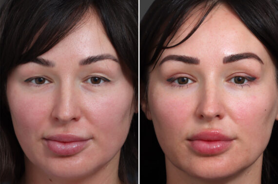 Upper Eyelid Surgery Before and After Photos in Princeton, NJ, Patient 19573