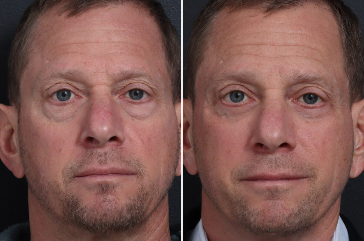 Upper Eyelid Surgery Before and After Photos in Princeton, NJ, Patient 19577