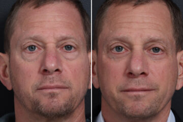 Upper Eyelid Surgery Before and After Photos in Princeton, NJ, Patient 19577