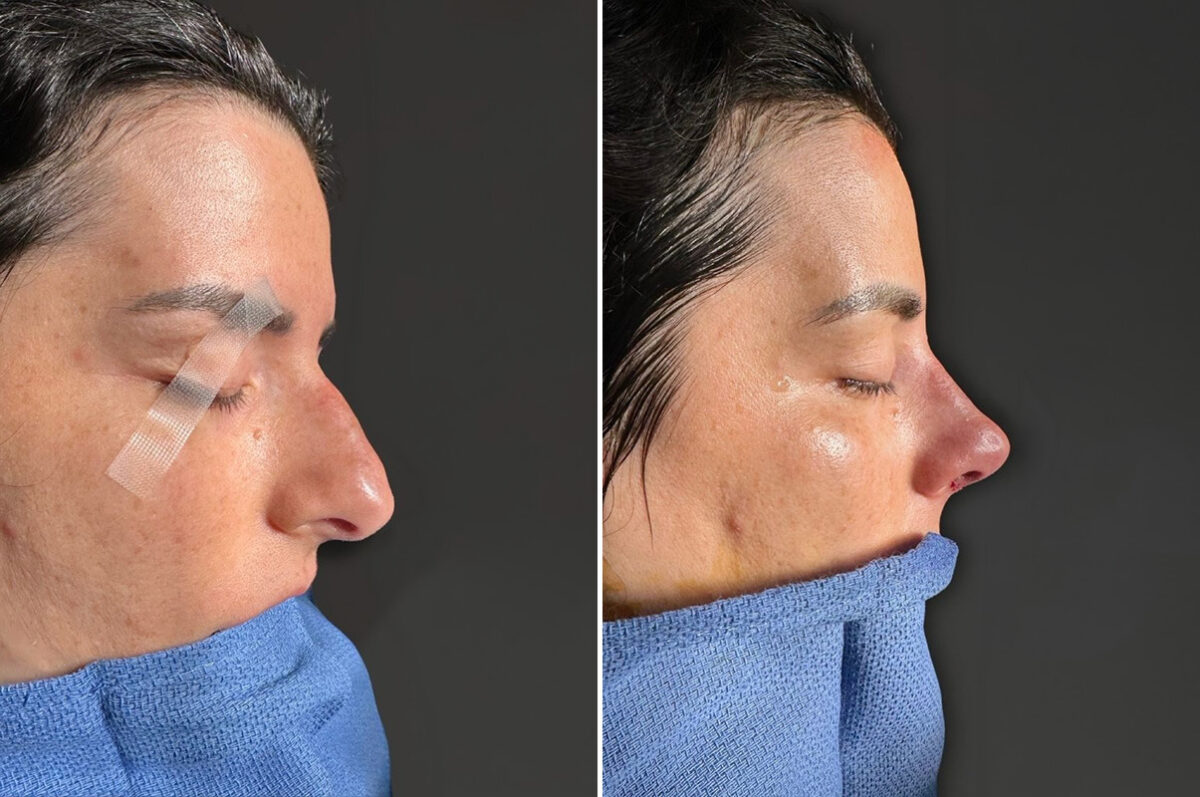 Rhinoplasty Before and After Photos in Princeton, NJ, Patient 19579