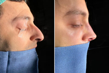 Rhinoplasty Before and After Photos in Princeton, NJ, Patient 19579