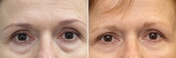 Lower Eyelid Surgery Before and After Photos in Princeton, NJ