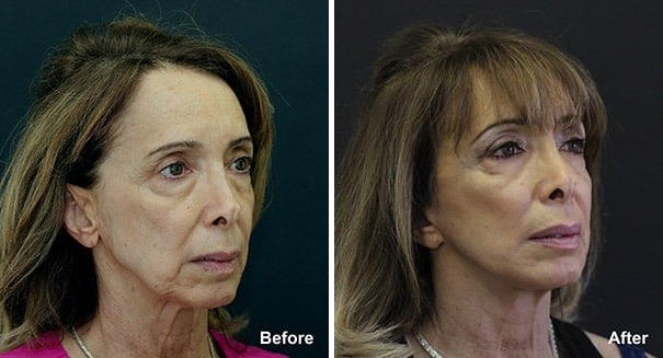 Fat Transfer Before and After Photos in Princeton, NJ, Patient 7891