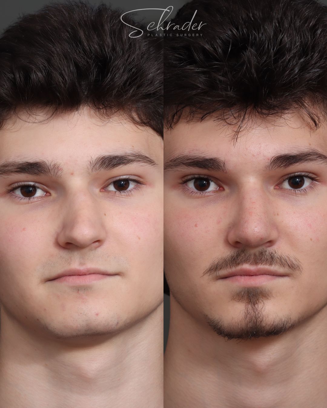 rhinoplasty-02-front