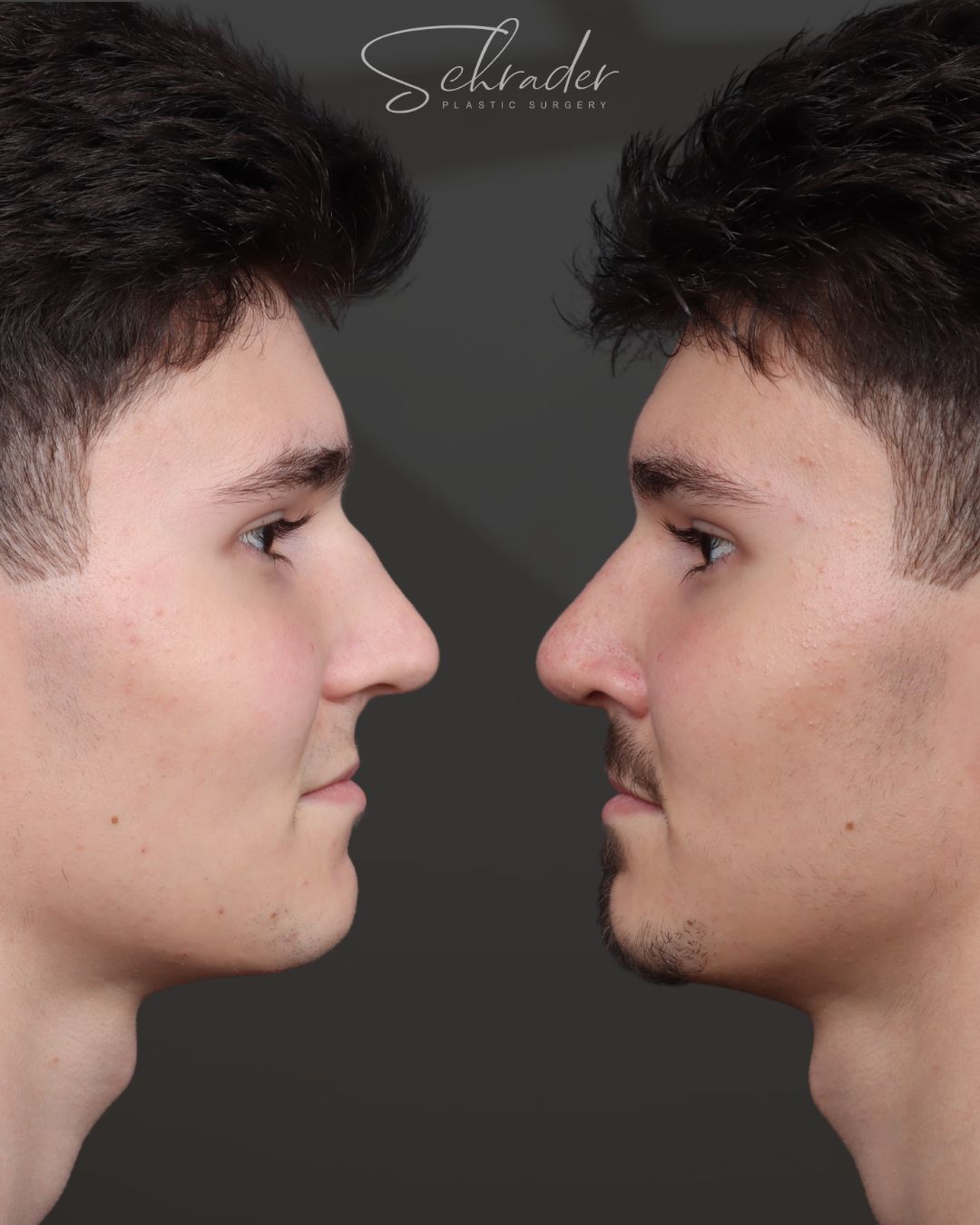 rhinoplasty-02-lat