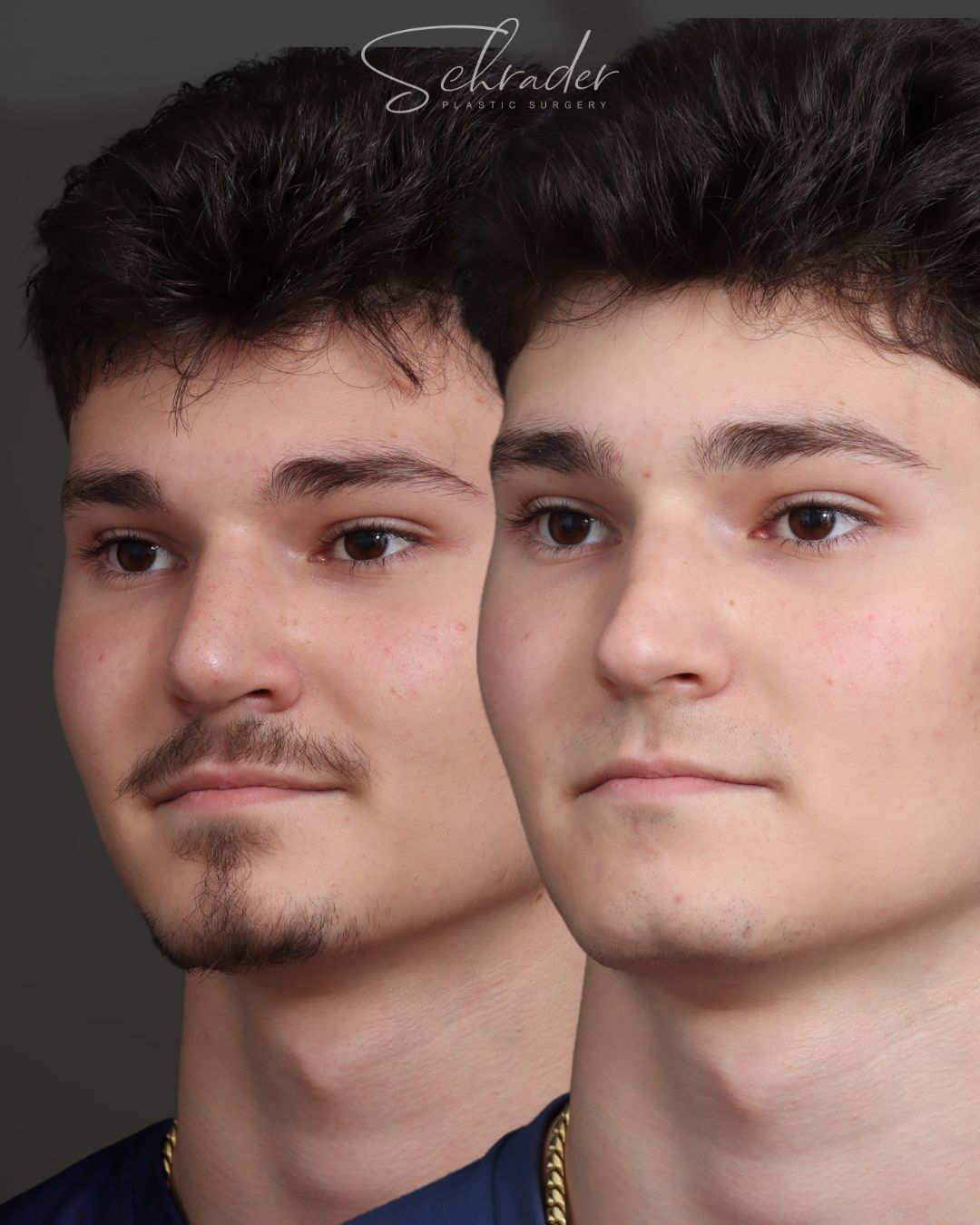 rhinoplasty-02-obl-left