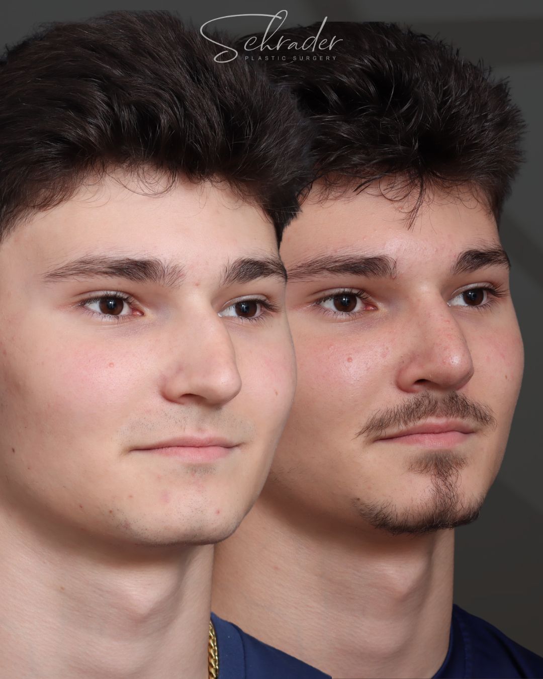 rhinoplasty-02-obl