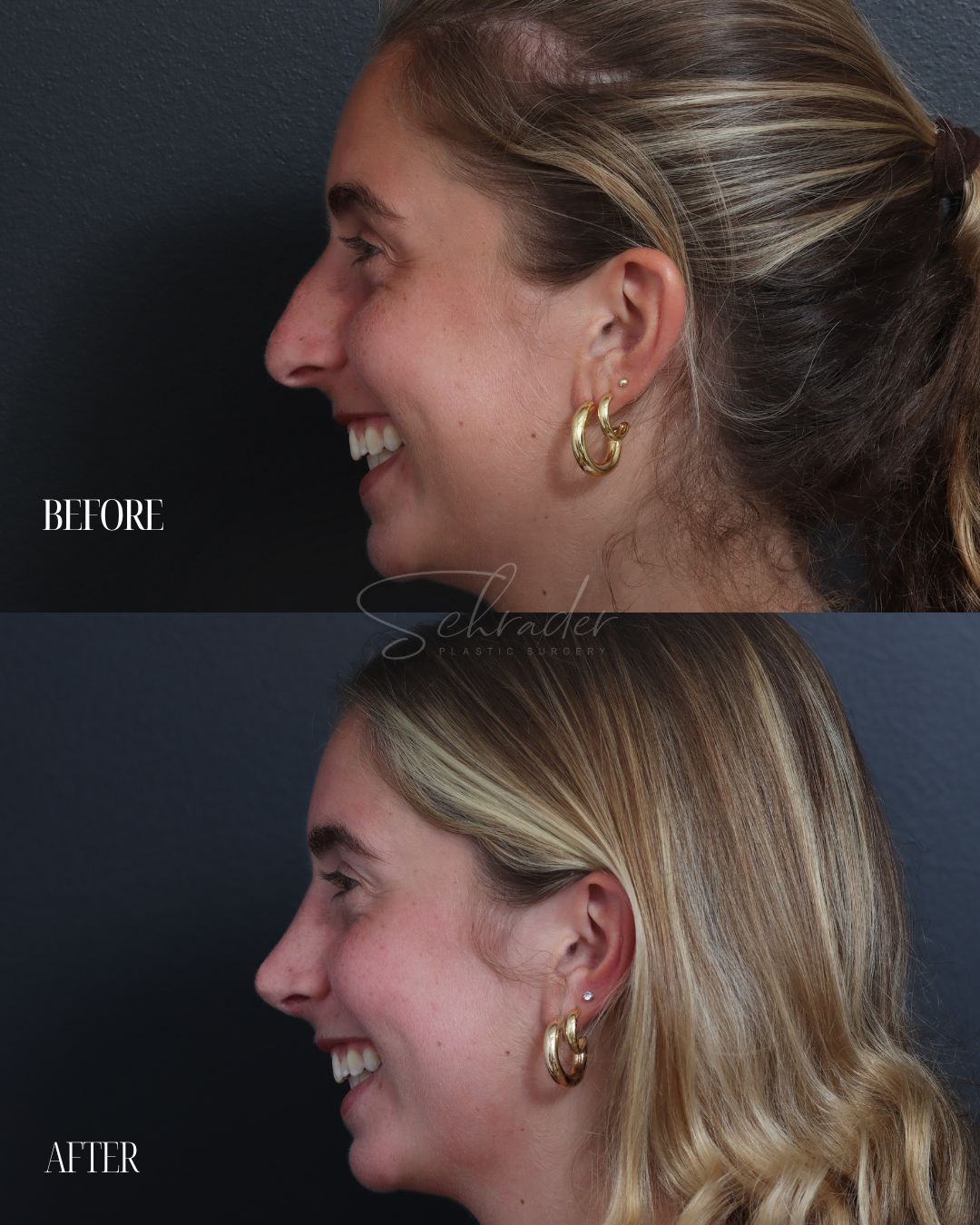 rhinoplasty-03-lat