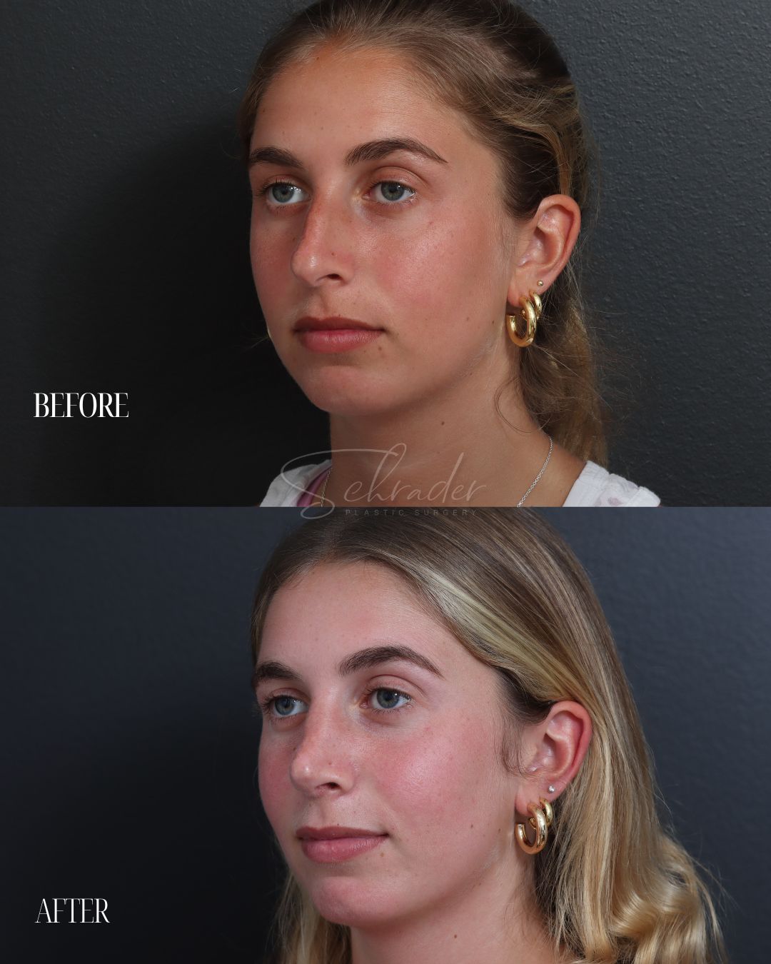 rhinoplasty-03-obl