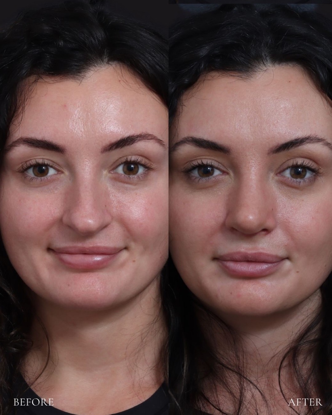 rhinoplasty-05-front