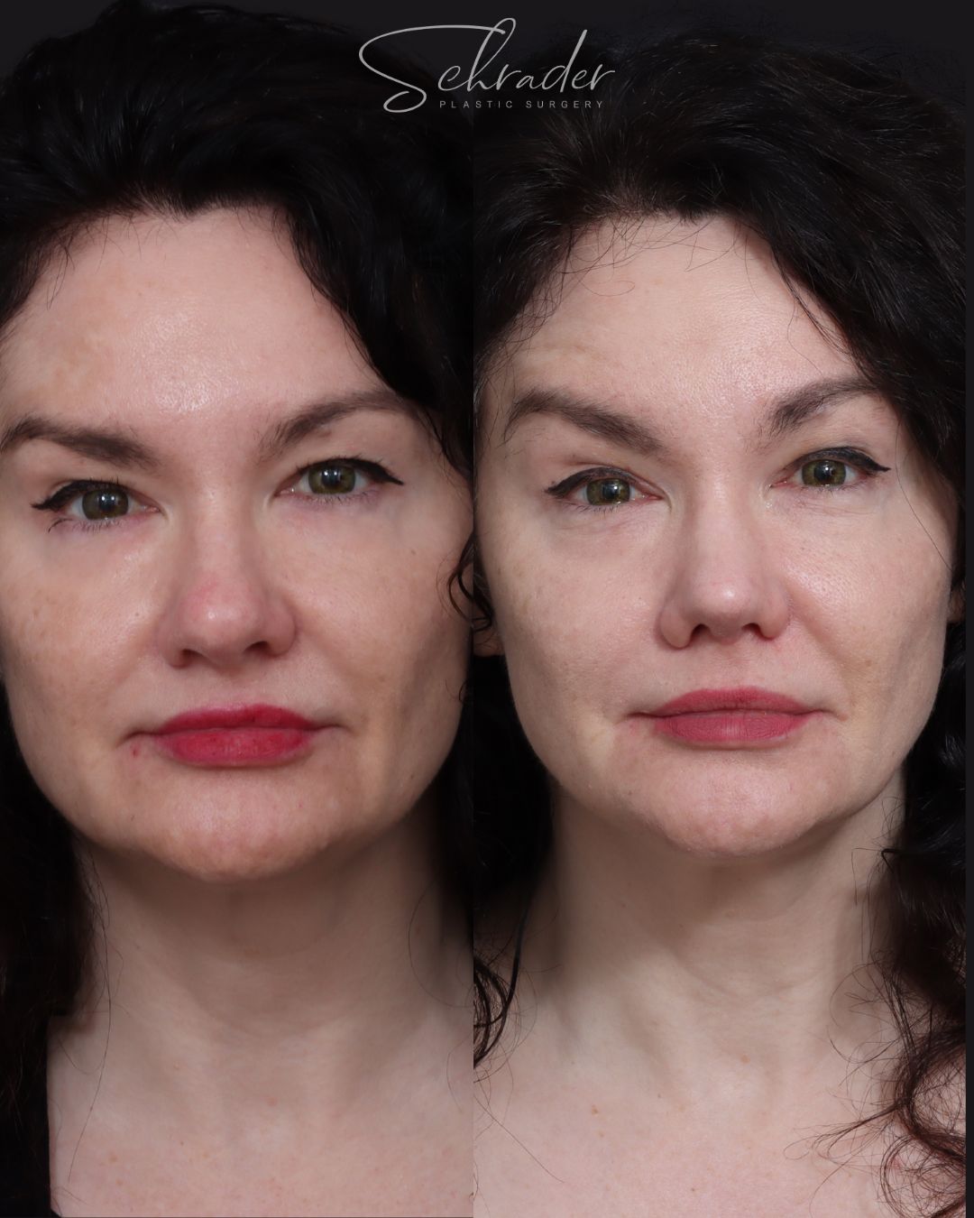 rhinoplasty-09-front