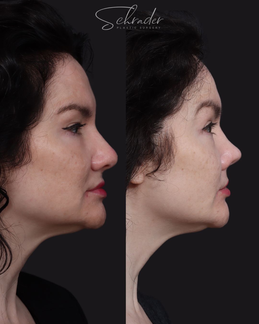 rhinoplasty-09-lat