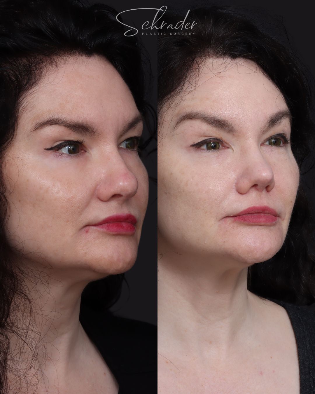rhinoplasty-09-obl