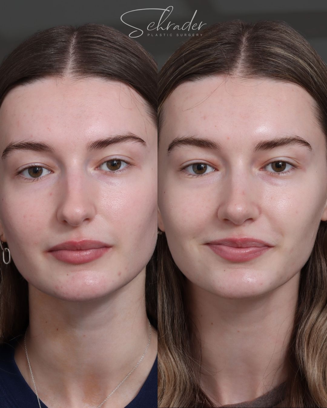 rhinoplasty-10-front