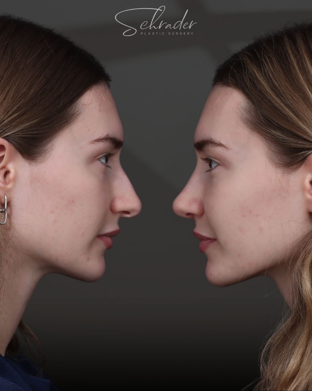 rhinoplasty-10-lat