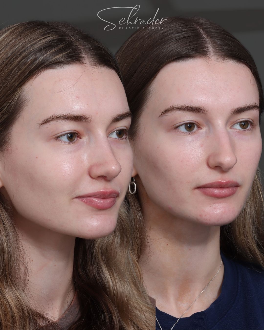rhinoplasty-10-obl