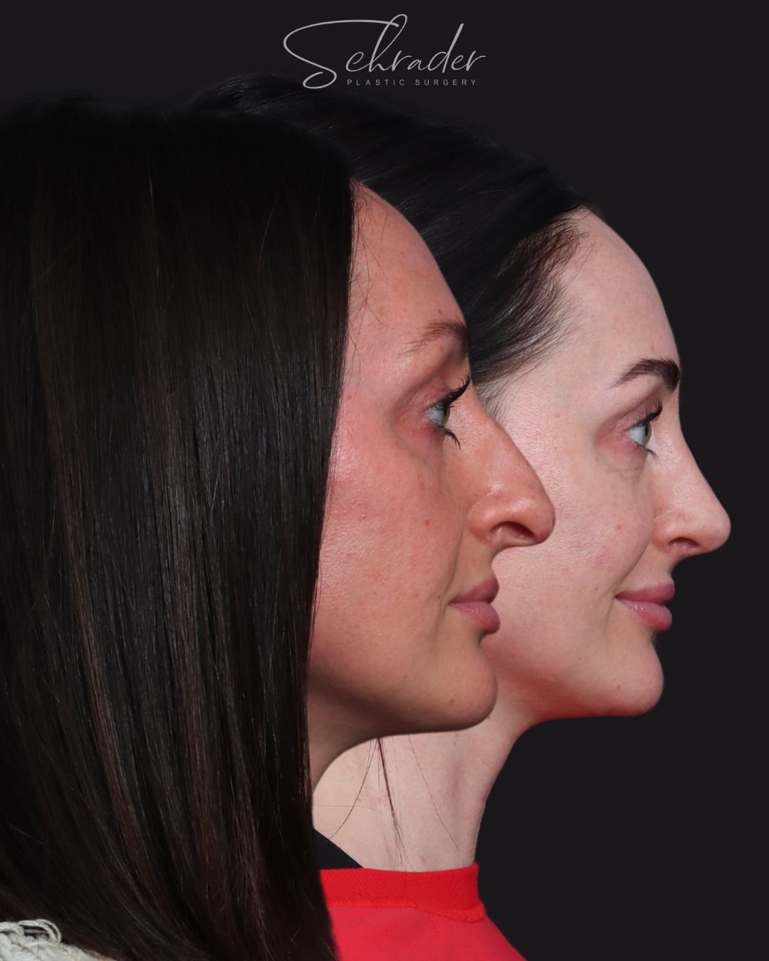 rhinoplasty-11-lat