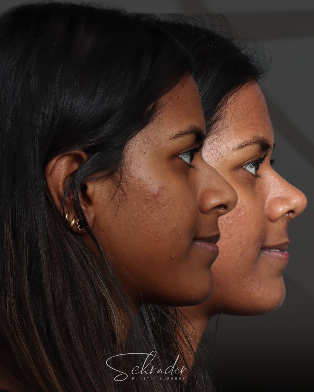 rhinoplasty-11-lat