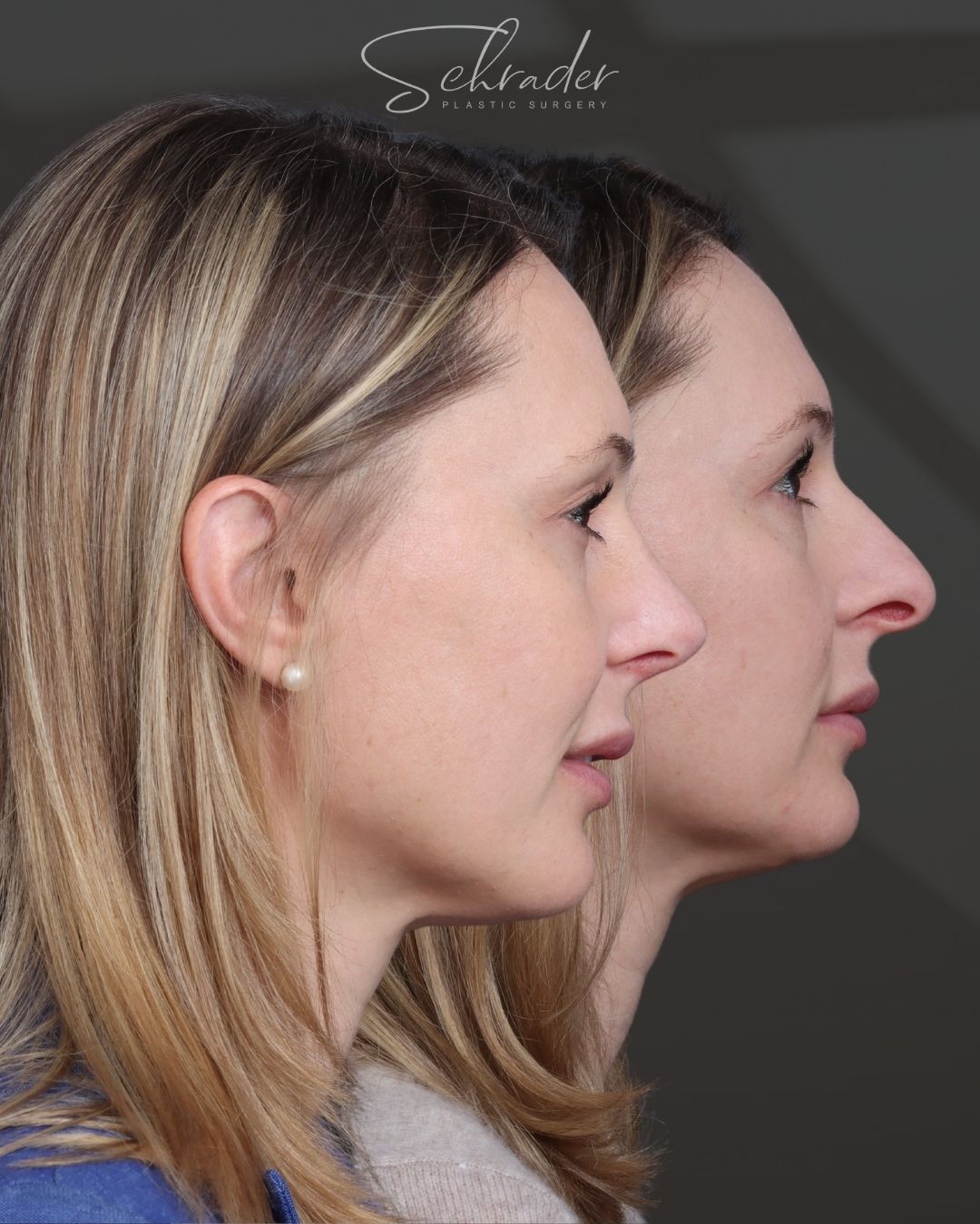 rhinoplasty-11-lat